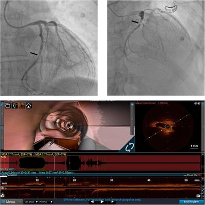 Case Report: Optical coherence tomography to guide PCI of iatrogenic injury of the circumflex artery after minimally invasive mitral valve repair